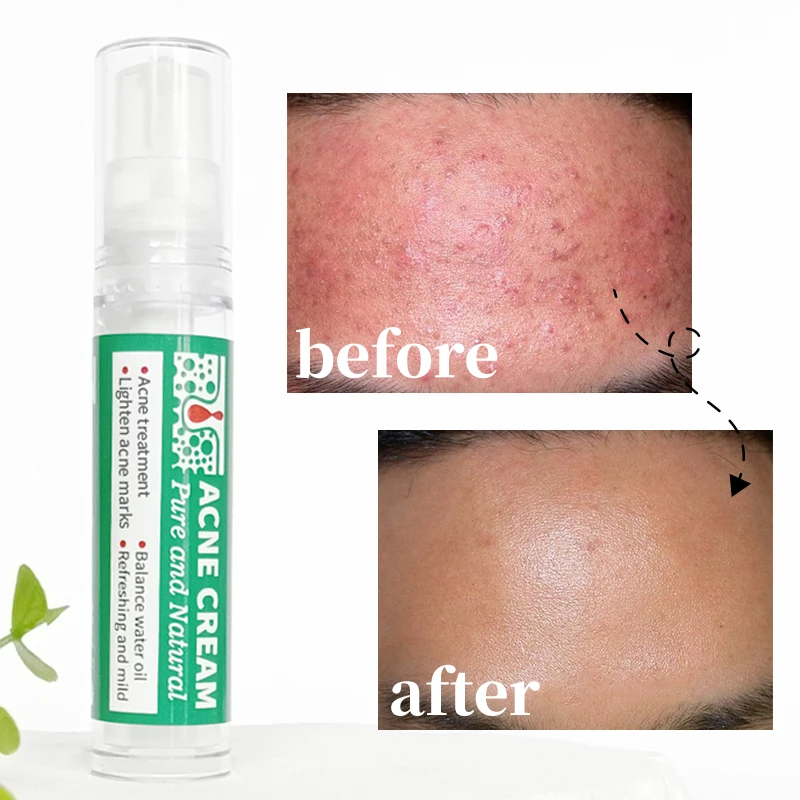 Custom Logo Skin Care Anti Aging Wrinkles Moisturiser Hyaluronic Acid Facial Firming Moisturising Aloe Vera Gel Anti Acne Cream