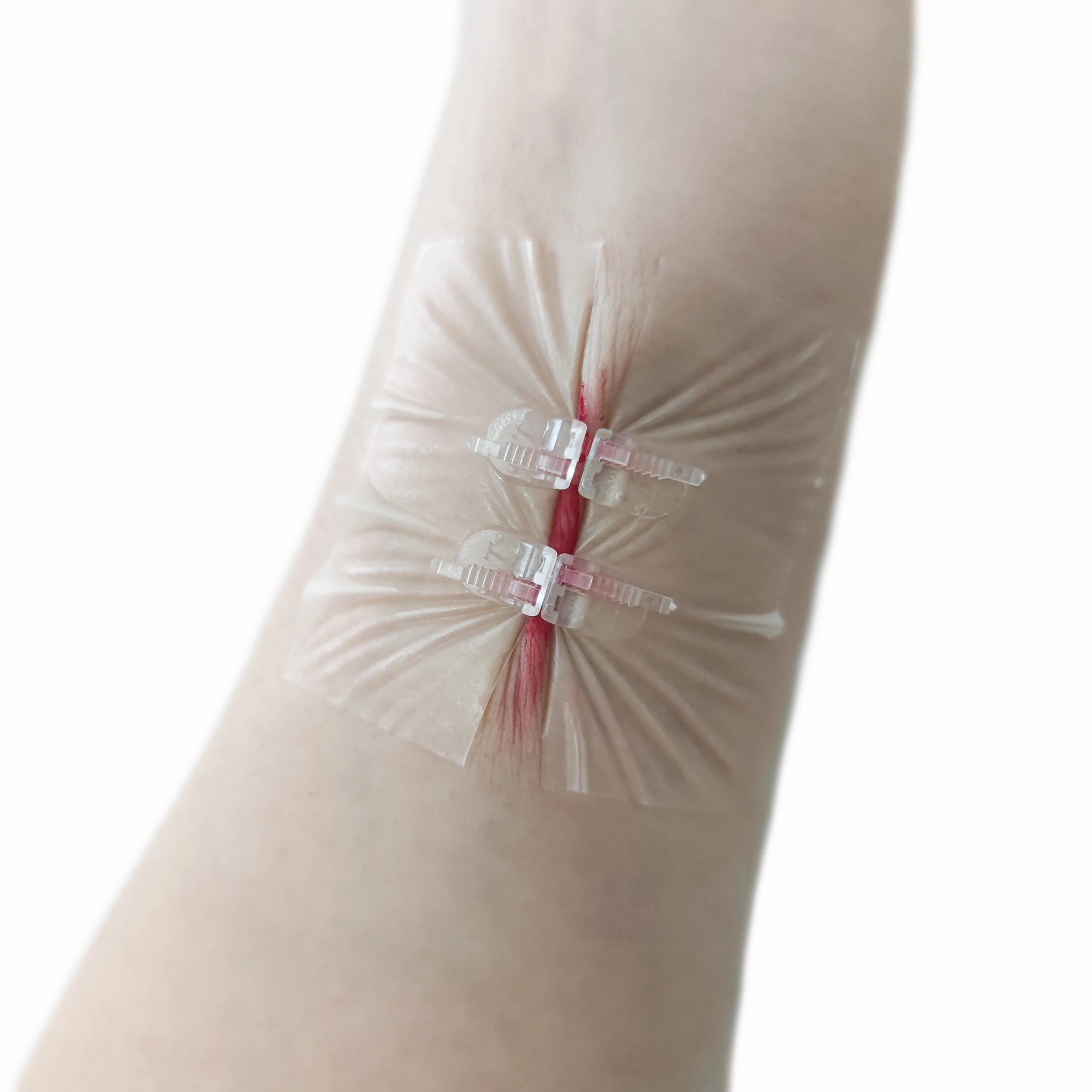 surgical incision wound skin closure strip set with zip tie