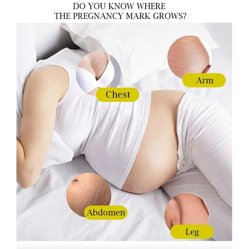 40%Off In Stock Upgraded Private Label Best Skin Repair Treatment Pregnancy Scars Remover Anti Stretch Marks Removal Cream