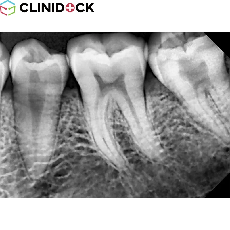 New Style Hot Selling Dental X-ray Unit CDX1006 Portable Mobile Dental Sensor Single Tooth X-ray Machine