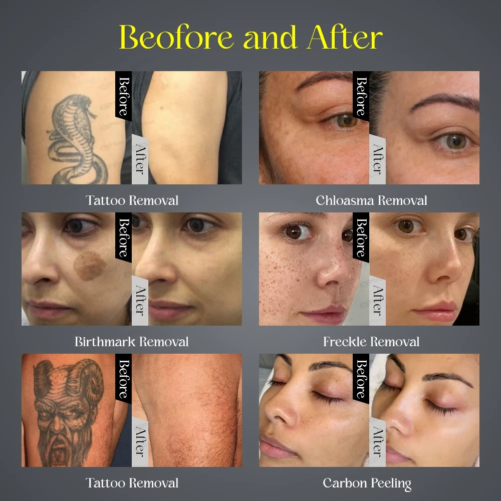 2024 picosecond laser pico laser tattoo removal machine price