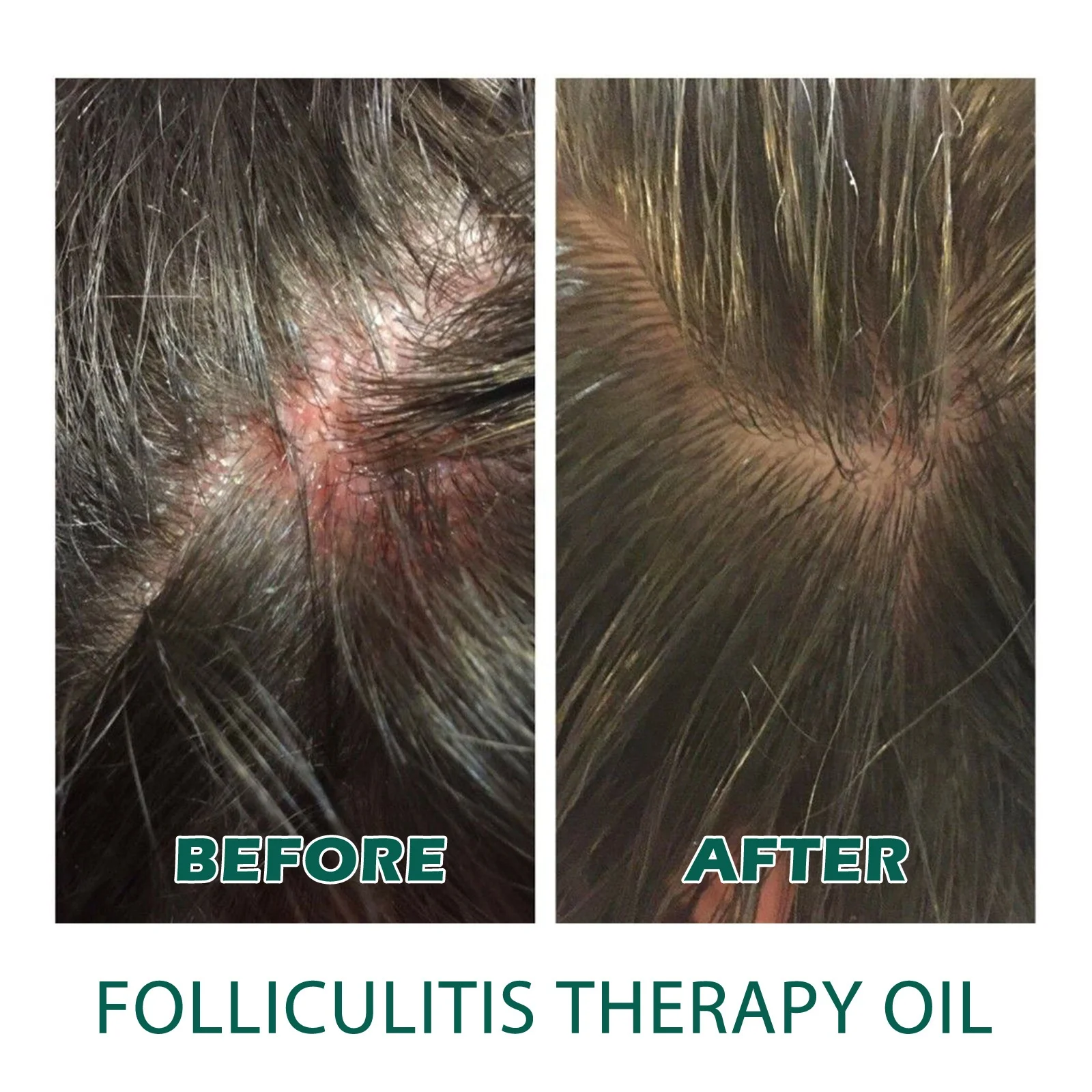 Herbal Hair Loss Treatment Restore Scalp Growth Hair products Best Hair Loss Solution Oil