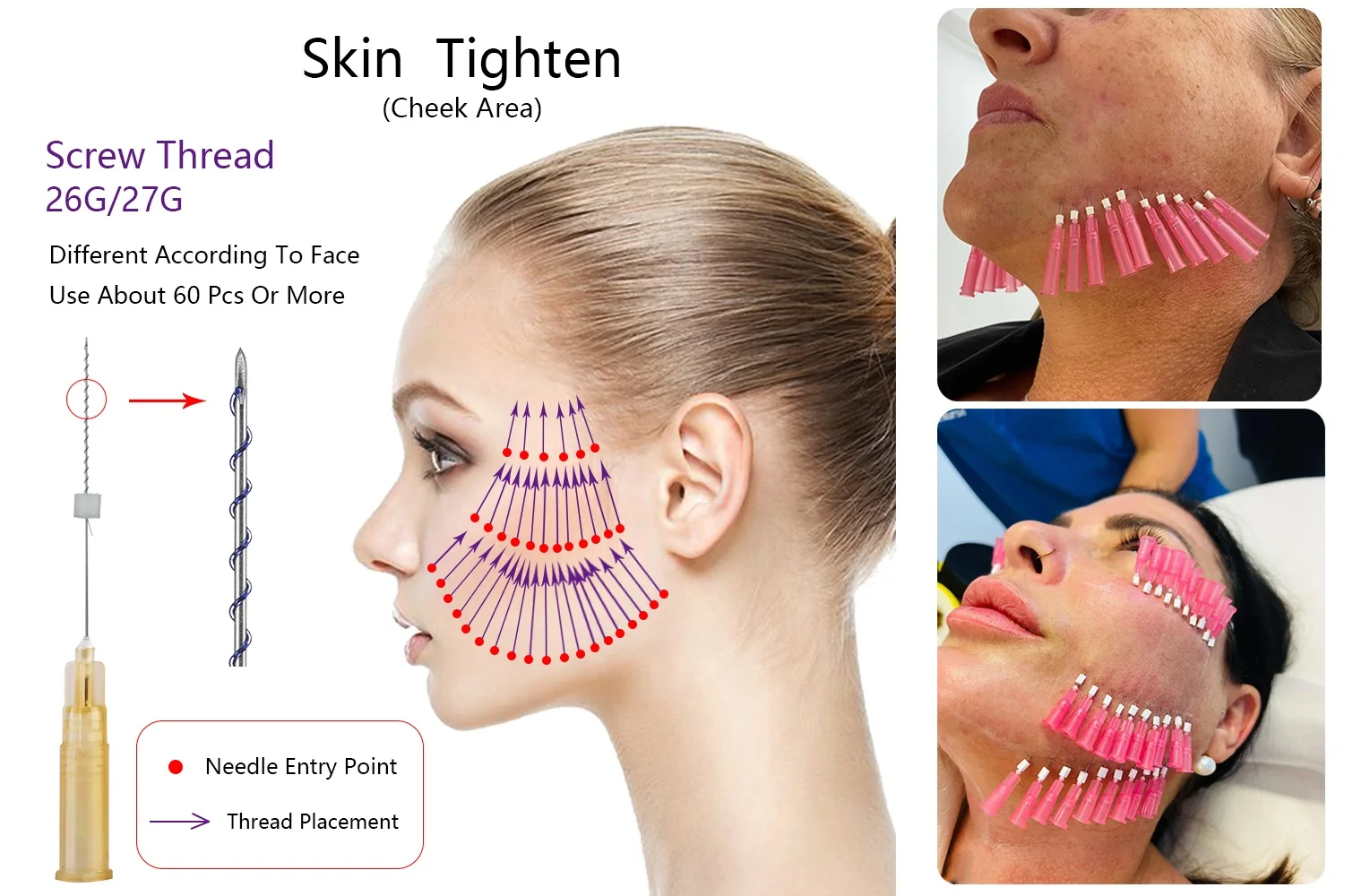 Pcl Fox Eyes Hilos Facial 26g 27g Sharp Neadle Korean Mesh Screw Cog Multi Pdo Lift Double Screw Threads Lift