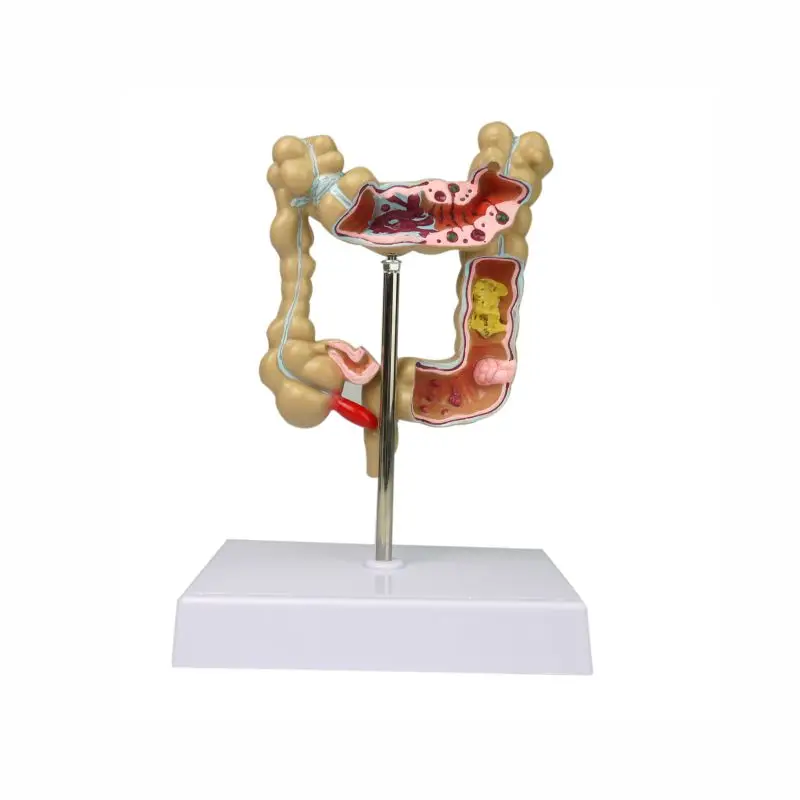 Медицинская анатомическая модель для коррекции кишечника медицинская обучающая человеческого патологического