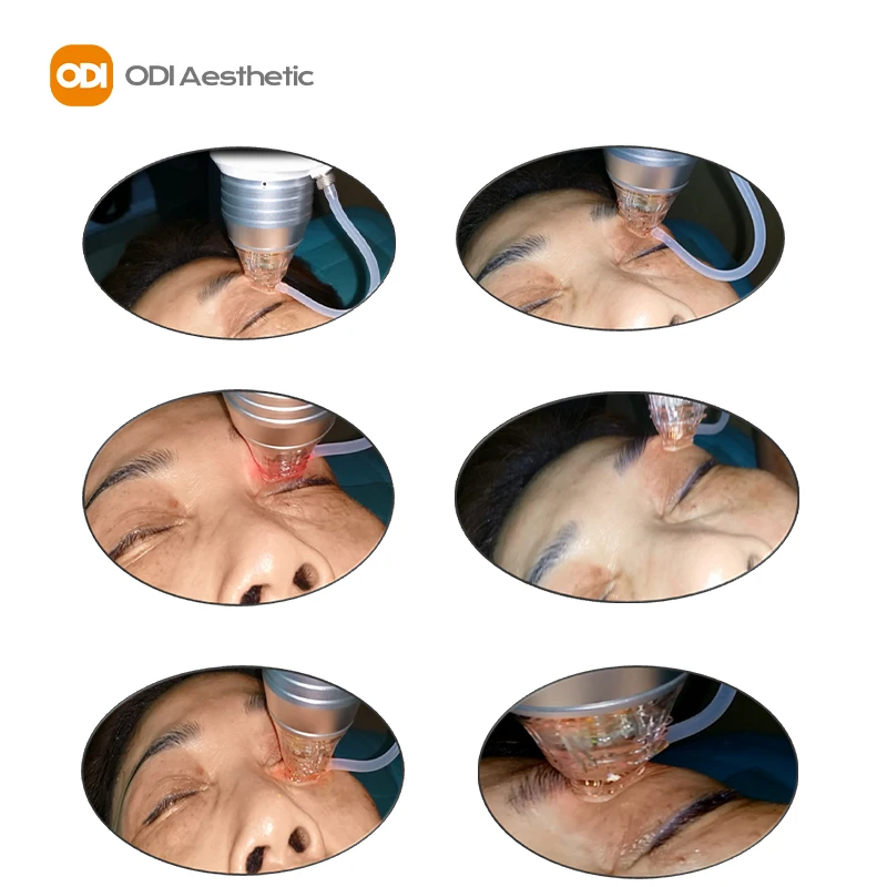 Rf Microneedling Machine Inus Microneedling Eyelids Face & Neck Lifting Stretch Marks Removal Korea Rf Microneedling Machine