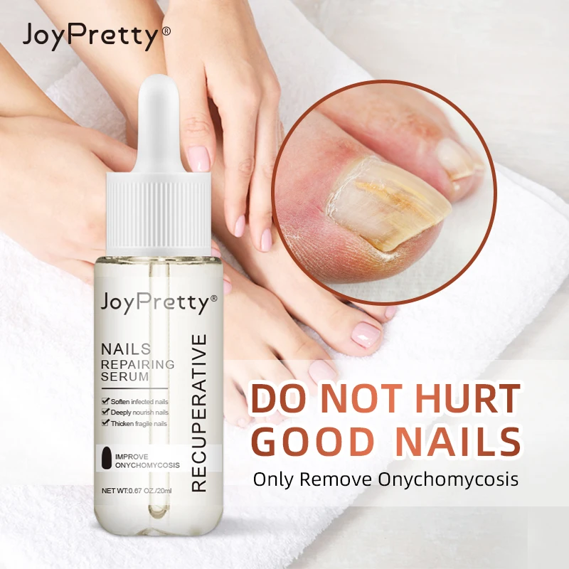 JoyPretty Fungal Nail Treatment Serum Foot Repair Essence Care Whitening Toe Nail Fungus Removal Gel Anti Infection 20ml