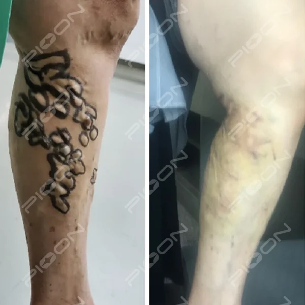 PIOON M2 1940nm Advanced EVLT/EVLA Vascular Surgical Diode Laser for Phlebology