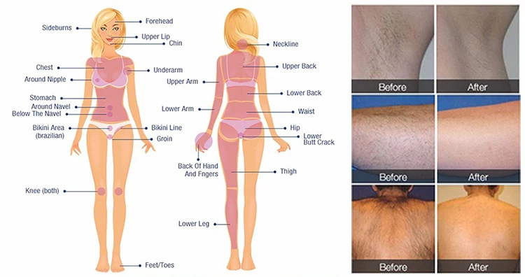 Intelligent diode laser with screen in the handle TEC cooling+ IPL skin rejuvenation 2 in 1 machine