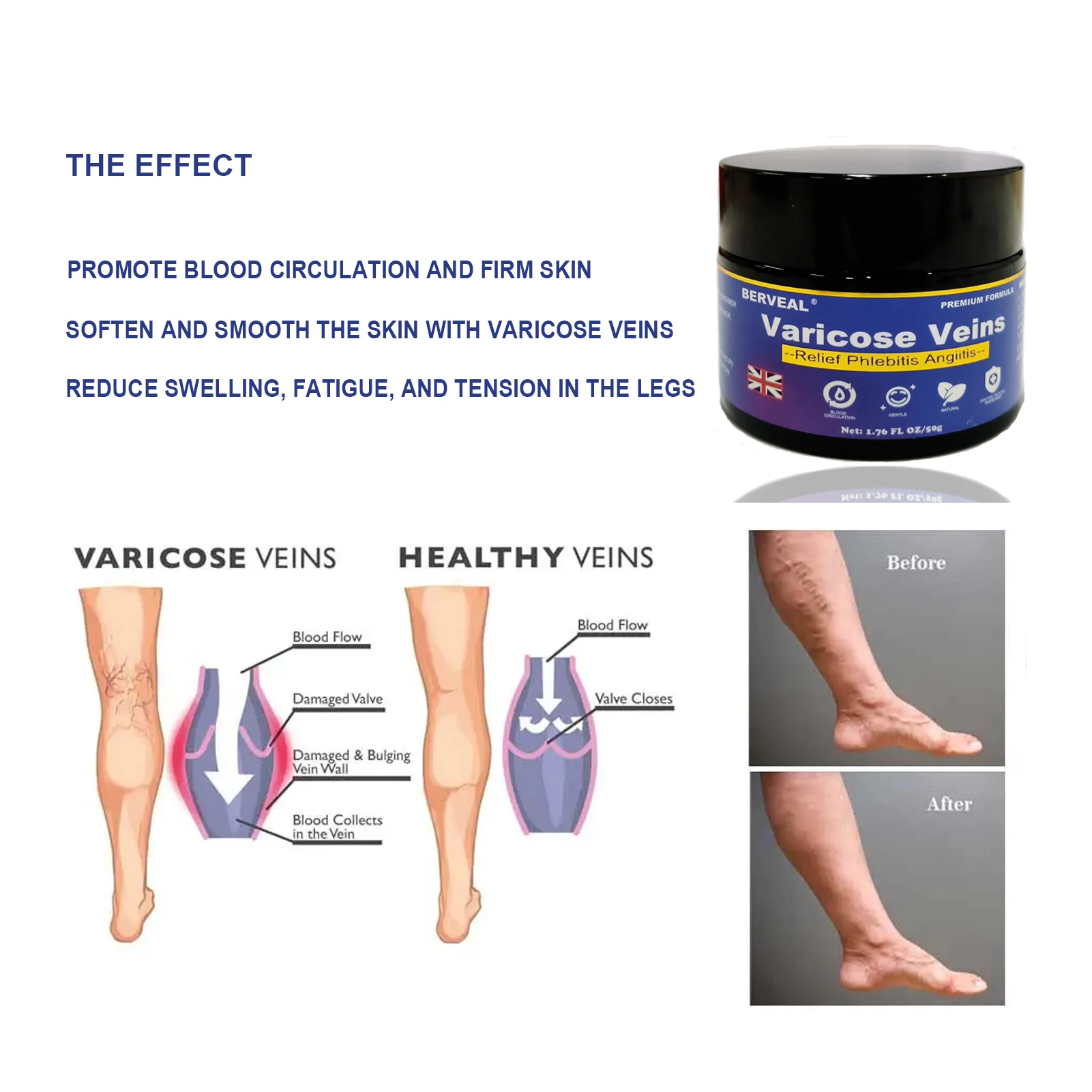 Varicose Veins Creams, Varicose Veins Treatment for Legs Suitable for Spider Veins, Improve Blood Circulation