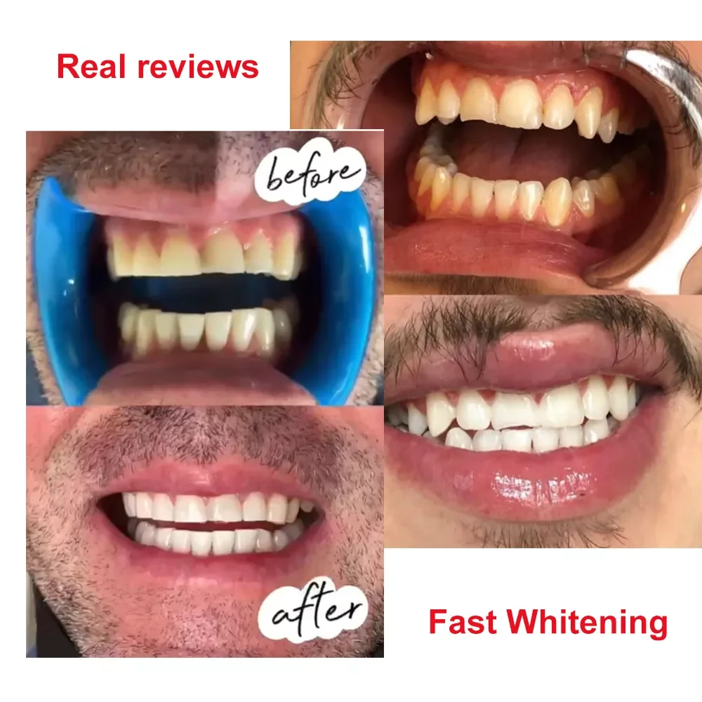 Teeth Whitening Gel Syringe Hydrogen Peroxide Whiten Dental Kits De Blanchiment Dentaire Professionnel