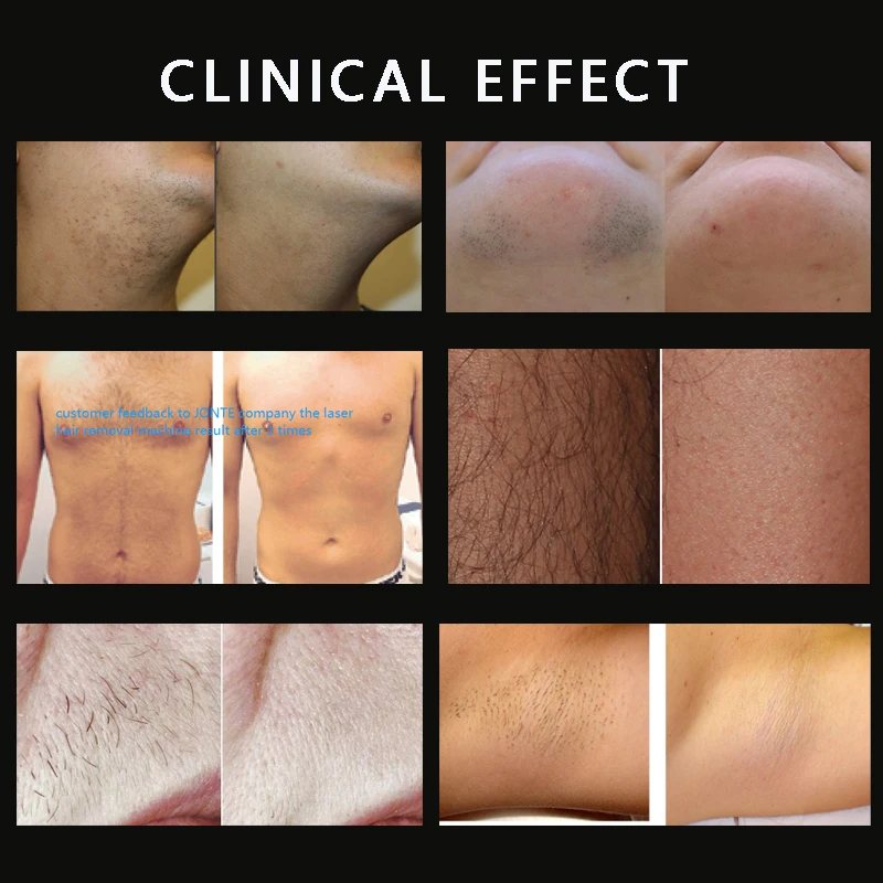 Professional Lazer Hair Removal 1064Nm&808Nm&755Nm Bars Diode Laser Hair Removal Machine