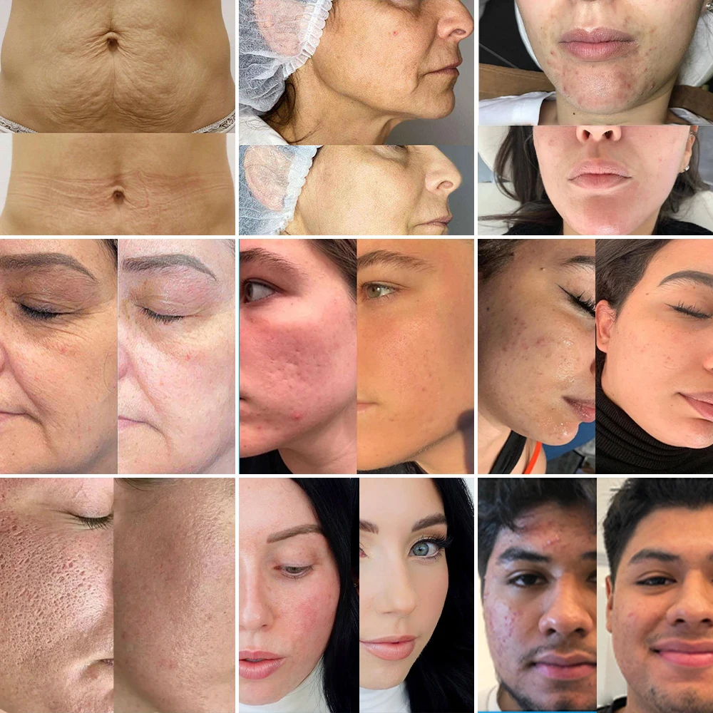 New Design ! Manufacturer Direct Sales ! what will a morpheus8 rf microneedling treatment d