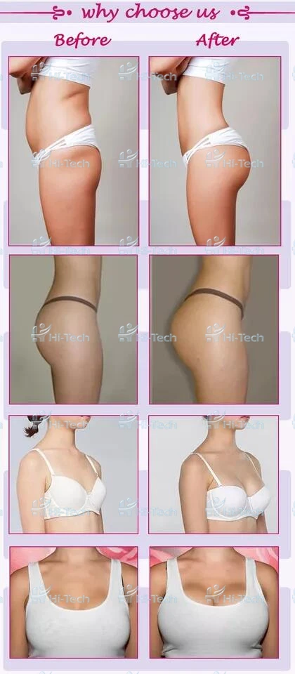 Acide Hyaluronique Hips Buttocks Liquid Breast Increase Dermal Filler Big Butt Enlargement Hyaluronic Acid Gel Injection