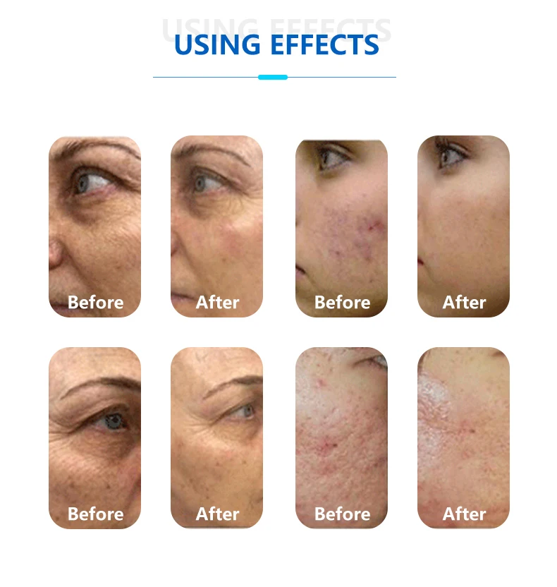 Y keylaser Hot Sell Skin Problem Solver 2 In 1 Rf Needles Remove wrinkles machine