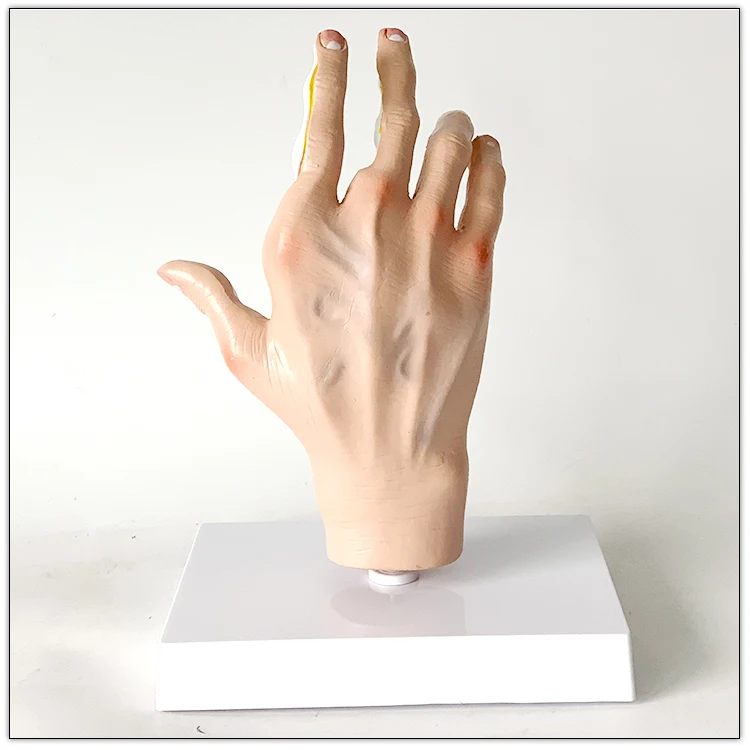 Anatomical model of human hand joint   Arthritis    Rheumatic fever