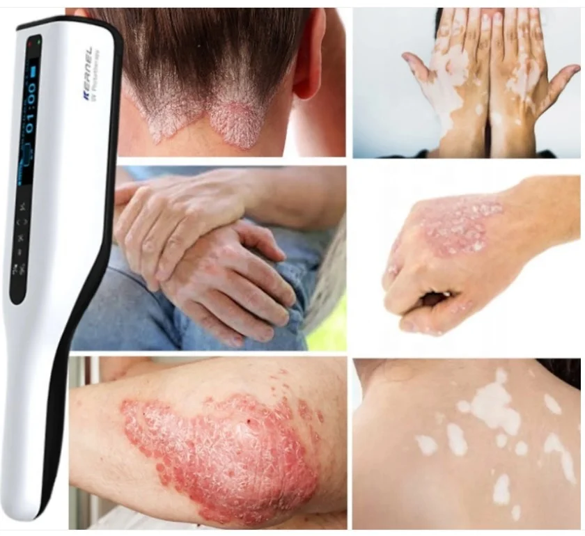 Medical PHILIPS UVB Hot selling handheld uvb phototherapy 311nm narrow band uvb lamps for psoriasis vitiligo