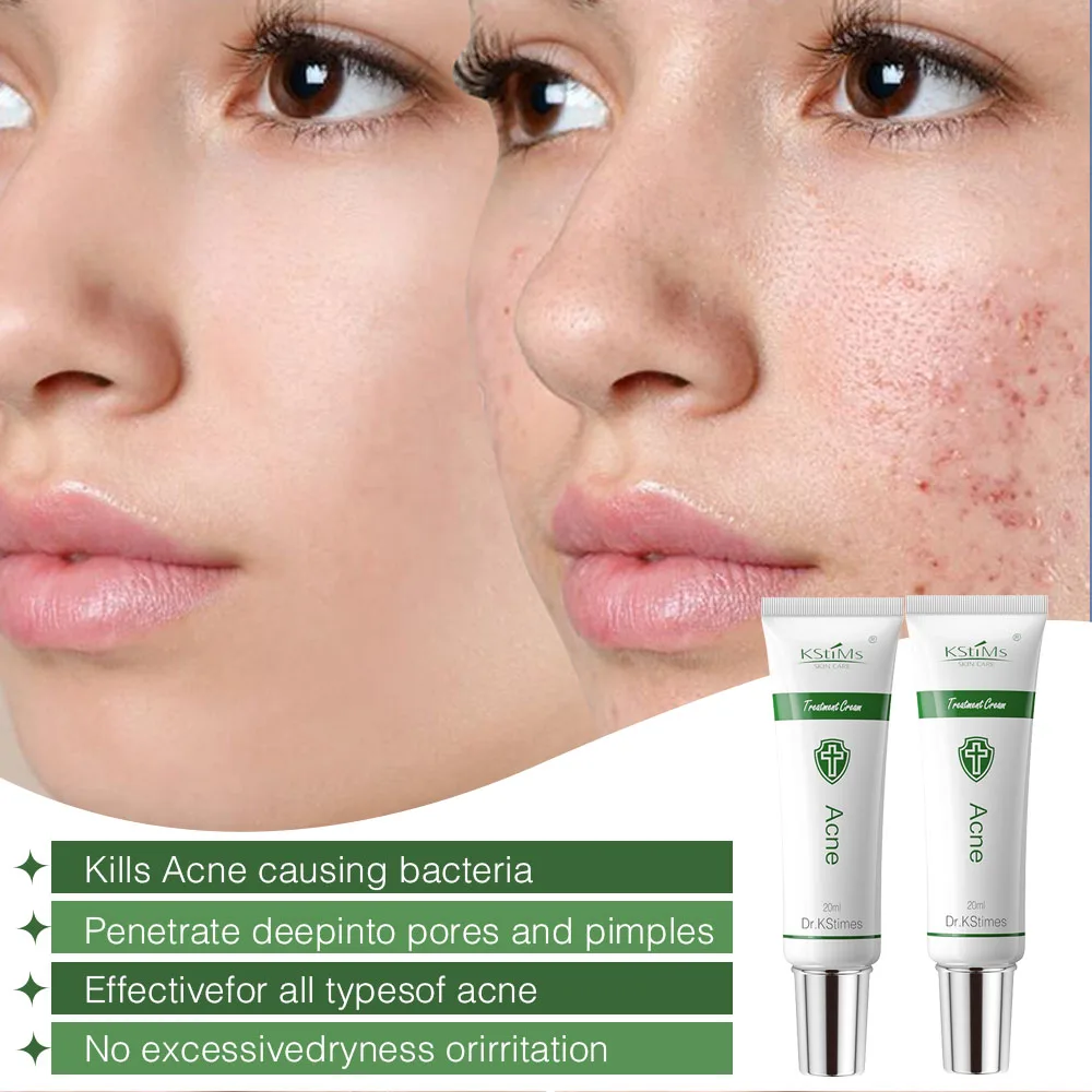 World Best Selling Korean Acne Face Cream for Acne and Pimples Treatment Anti Acne Facial Cream