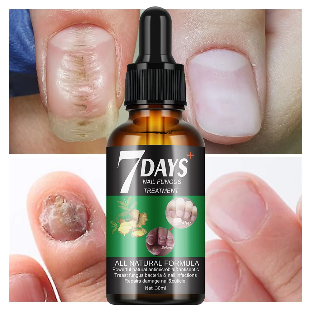 2024 New Arrival 7 Days Nail Fungus Treatment Serum Repairs Damage Nail & cuticle Skin Care Products 30ml Nail Serum