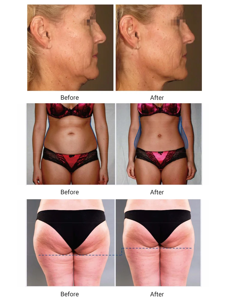 Dual Aluminum Handpieces Roller Massage Endo Roller Body Slimming Machine Rolling Therapy for Muscle Relax Lymphatic Drainage