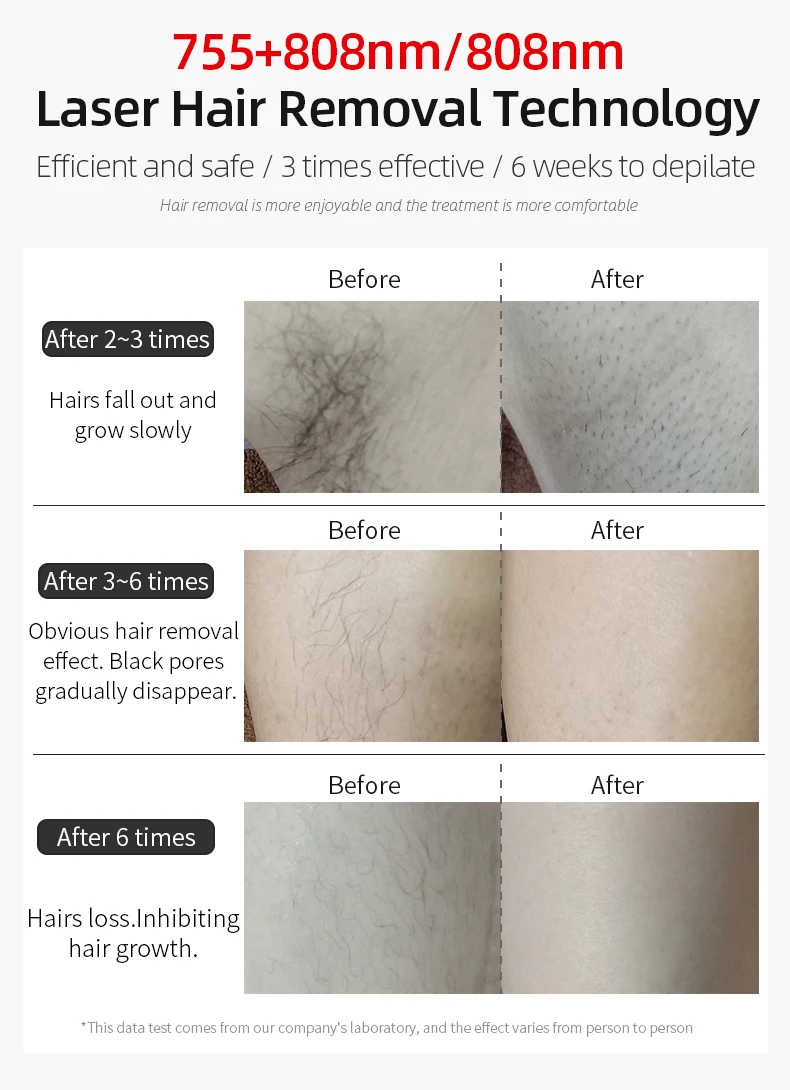 Diode Laser Permanent Painless Hair Removal Machine for Home Home Mini 3 Wavelength 755nm 808nm 1064nm Portable 2000W 11mm*11mm