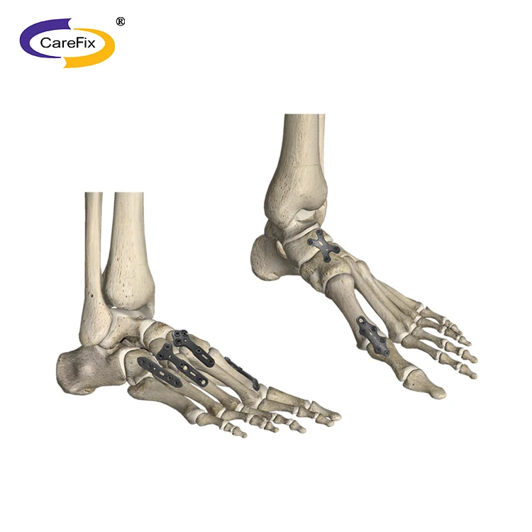 Straight Locking Mini Plate screw for foot ankle elbow fracture LCP meditech orthopedic implants