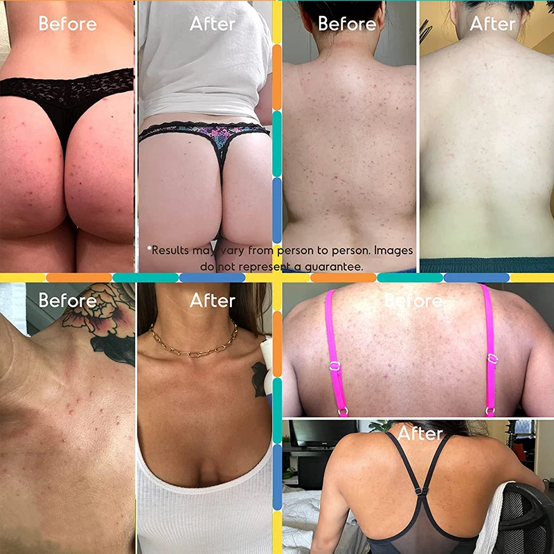 Private Label Skin Care 100% Organic Natural Citric Acid Mandelic Acid Acne Scar Removal  Anti Acne Serum Face Serum