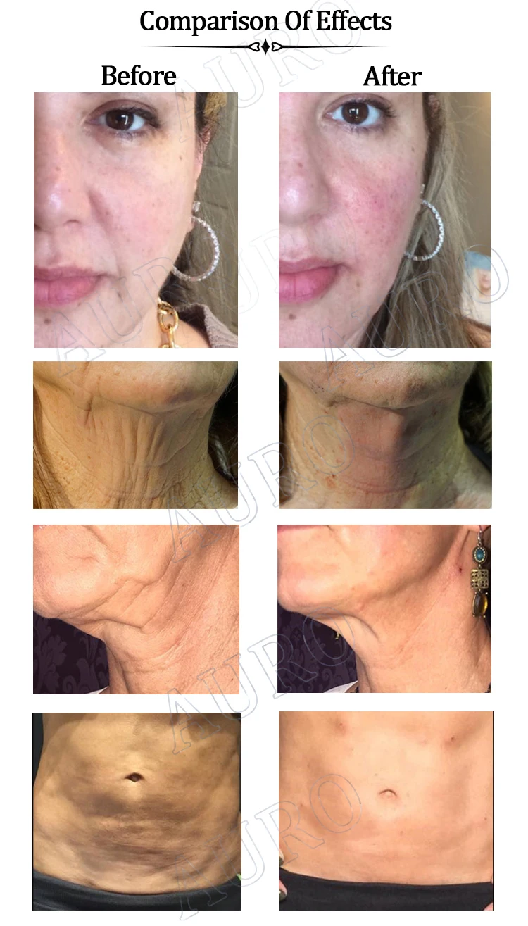 Cosmetic surgery face and neck thread lift fios pdo material natural collagen mono 30g 25mm sharp needle