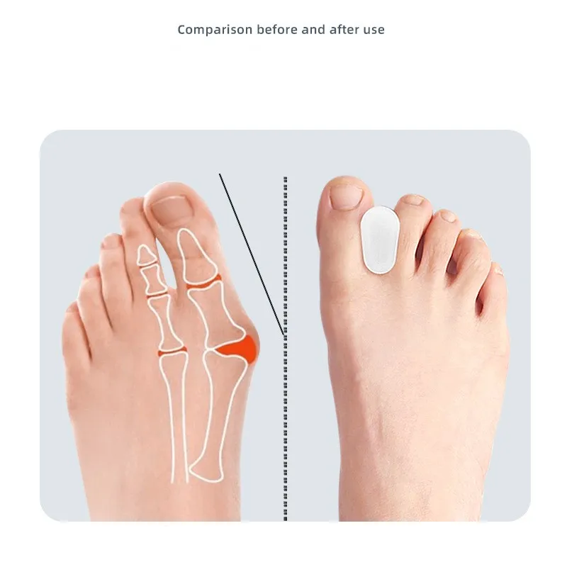 Toe valgus orthosis