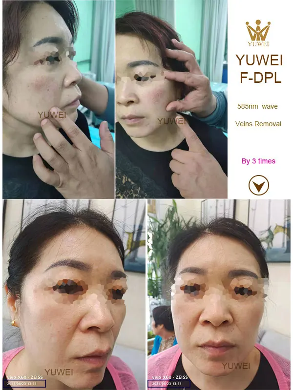 Multi-Functional Laser Hair Removal Rf Beauty Machine Ipl F-Dpl Laser Hair Removal System