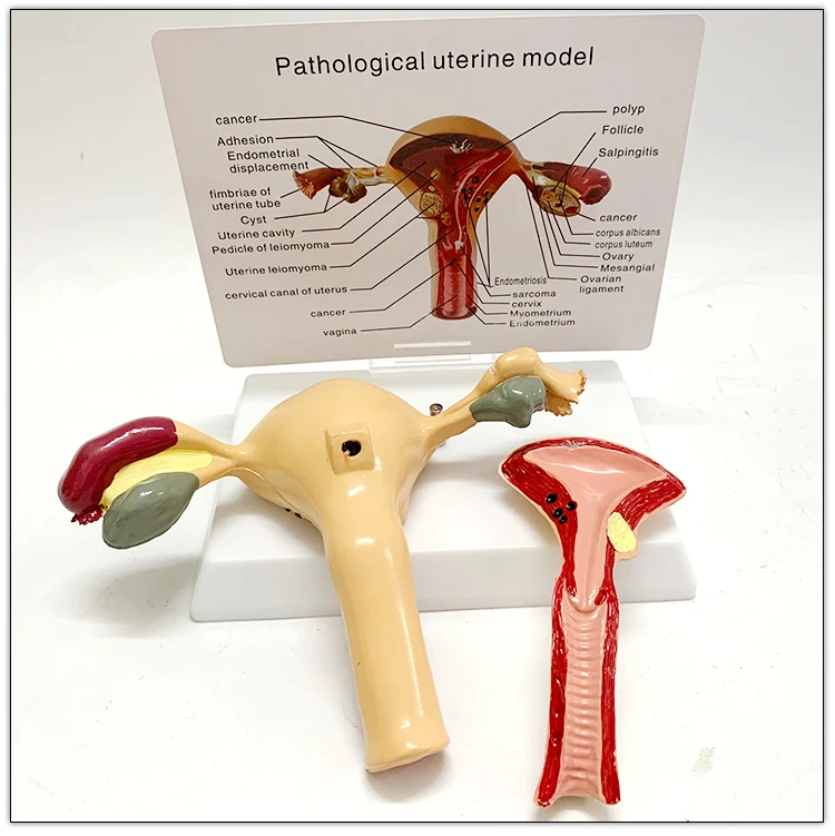 Standard price medical anatomical uterus teaching models of the uterine leiomyomas