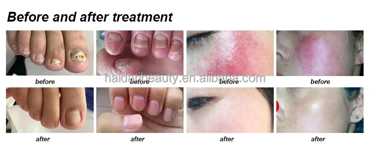 980nm diode laser (4)_(1).jpg