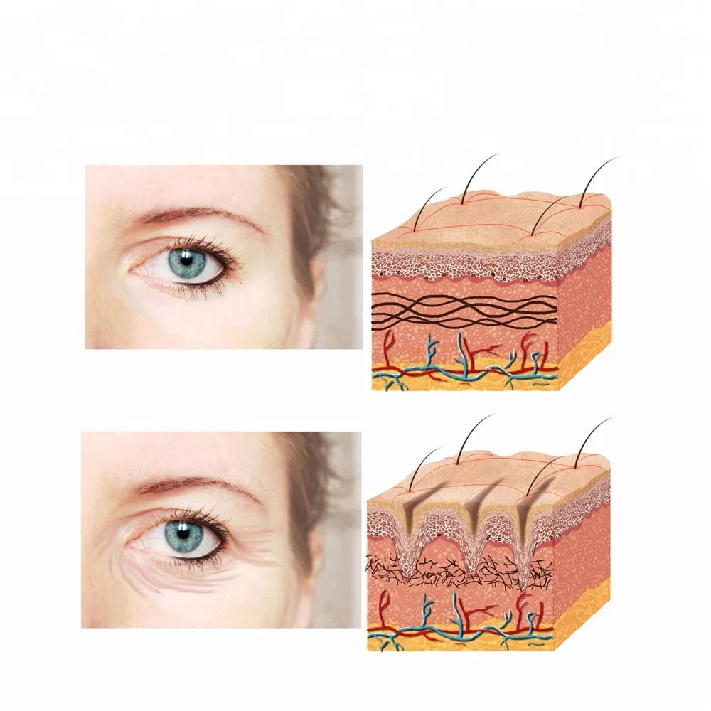 Korean raising eyebrows Perfect thickness and length, without scars pdo lifting threads