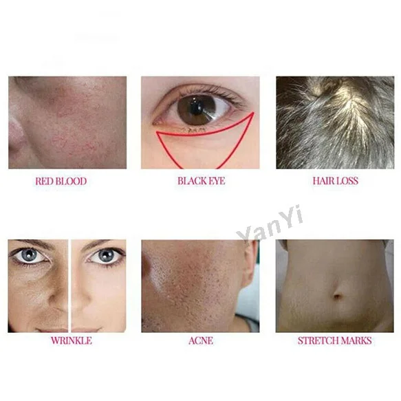 YanYi перезаряжаемая Дерма-ручка, 7 цветов, светодиодная Дерма-ручка