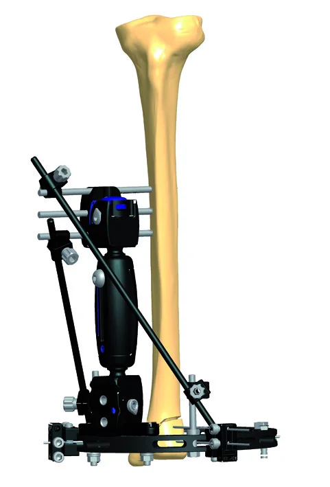 
Hot Sale Black Stainless Steel Elbow Joint External Fixator 