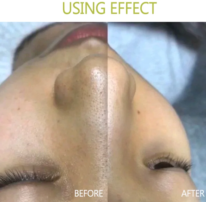 New Arrival Hot Selling  Modified Jessner Peel for Acne Hyperpigmentation Chemical Peel Solution for Skin Whitening