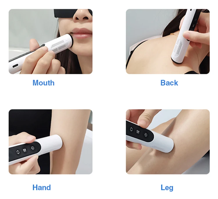 Custom Yonker handheld UVB phototherapy 308nm 5V type c Uv light therapy lamps treatment of psoriasis and vitiligo at home