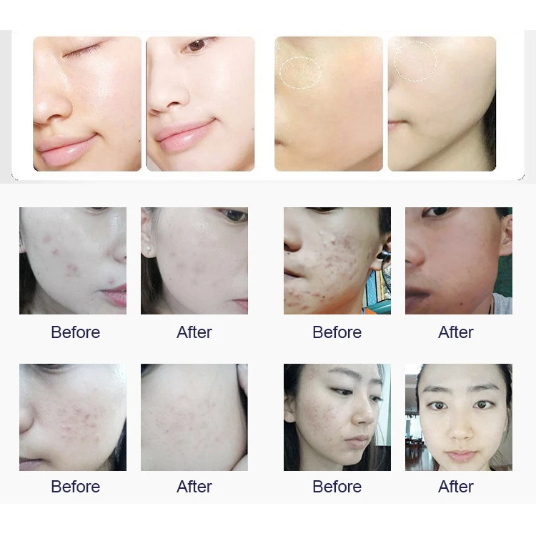 Portable Microdermabrasion Peeling Needleless Injection Oxygen Jet Machine Dermabrasion Machine Microdermabrasion