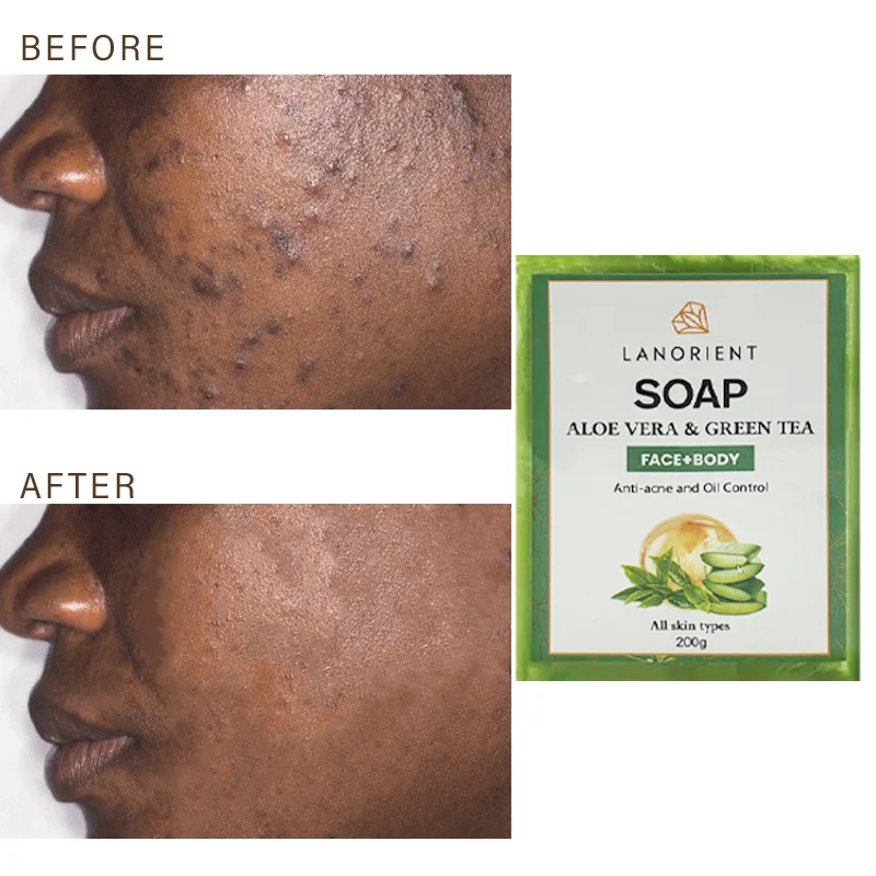 2024 New Face Body Care Products LANORIENT 200g Moisturizing Anti-Acne Repair Skin Damage Aloe Vera Handmade Soap