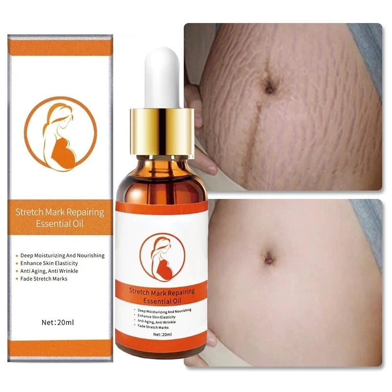 Stretch Marks Remover Essenti al Oil Skin Care Stretch Mark Cream For Stretch Mark Removal Maternity Slackline For Pregnant Oils
