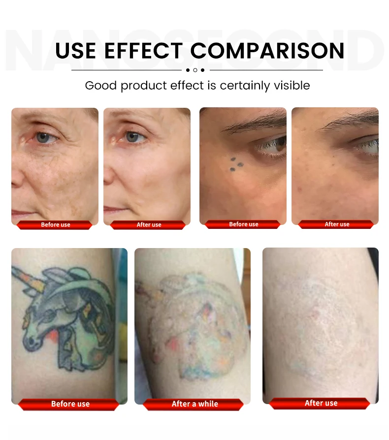 Professional PicoLaser 532 755 1320 1064 Pico Second Tattoo Removal Laser Machine Pico Laser Tattoo Removal Picosecond