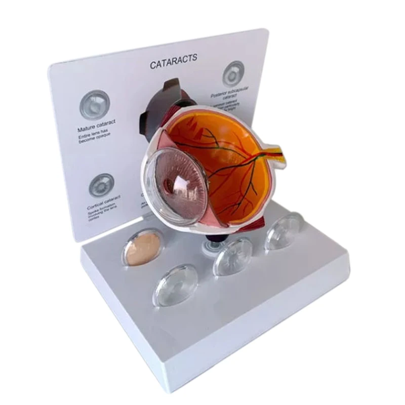 educational advance enlarged human  cataract eye  model for sale with eye anatomical verve