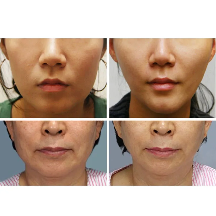 Care Hair Removal Laser Machine Ipl Laser Rf Hair Removal Skin Care Device To Remove Hair Brown