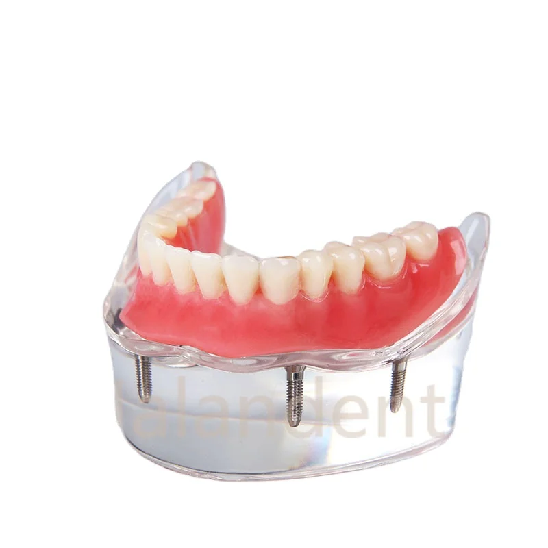 High Quality Mandibular Overdenture Implant Teeth Model With 4 Implants Dental Teach Tooth Model  Dental Teeth Model