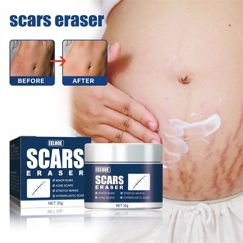 EELHOE scars eraser minor bum acne stretch mark removing no scars cream hyperplastic scar removal cream for women man