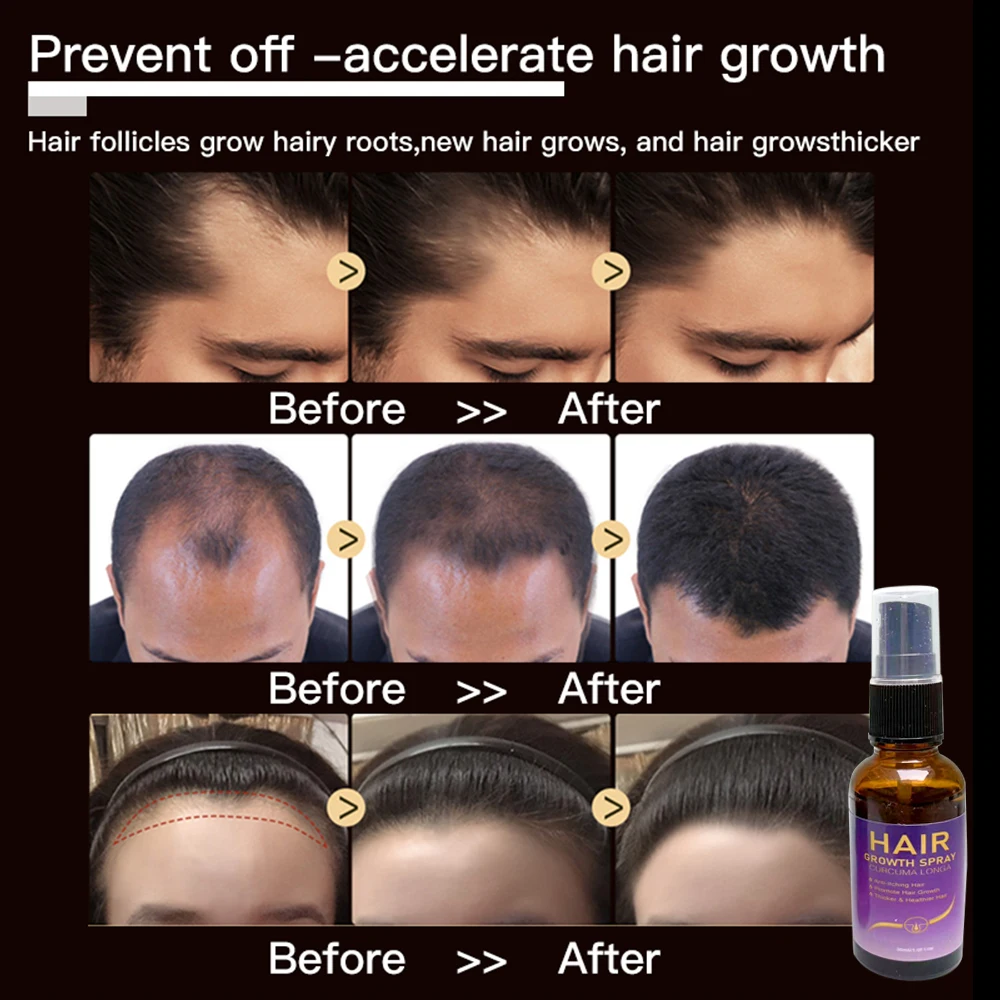 New Ginger Hair Care Growth Serum Hair Loss Treatment Spray 7 Days Effective Germinal Hair Growth Essential Oil