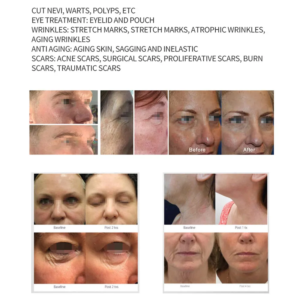 roller Jet needle mole removal Plasma for Face roller Plasma Looking For Distributor Eyelid Tightening And Lifting Plasma pen