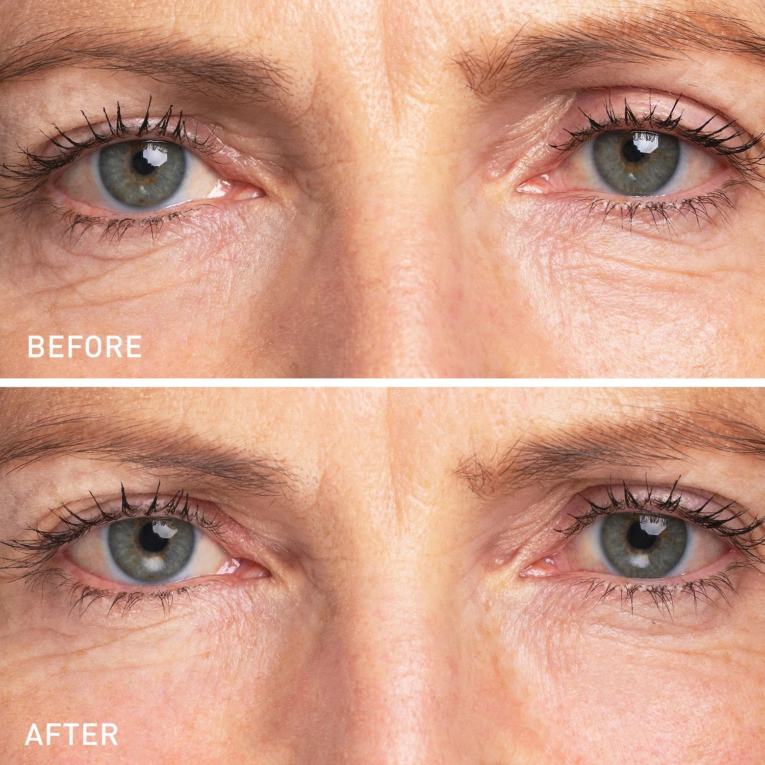 Micro Dart Patch Custom Eye Patches Antiwrinkle With Microneedle Collagen Micro-needle Eye Patches