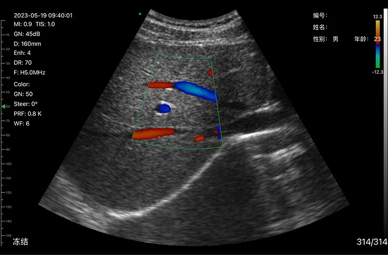 Suresult Color Doppler On-the-Go Solutions For Emergency Medicine: Portable Ultrasound With Convex Probe
