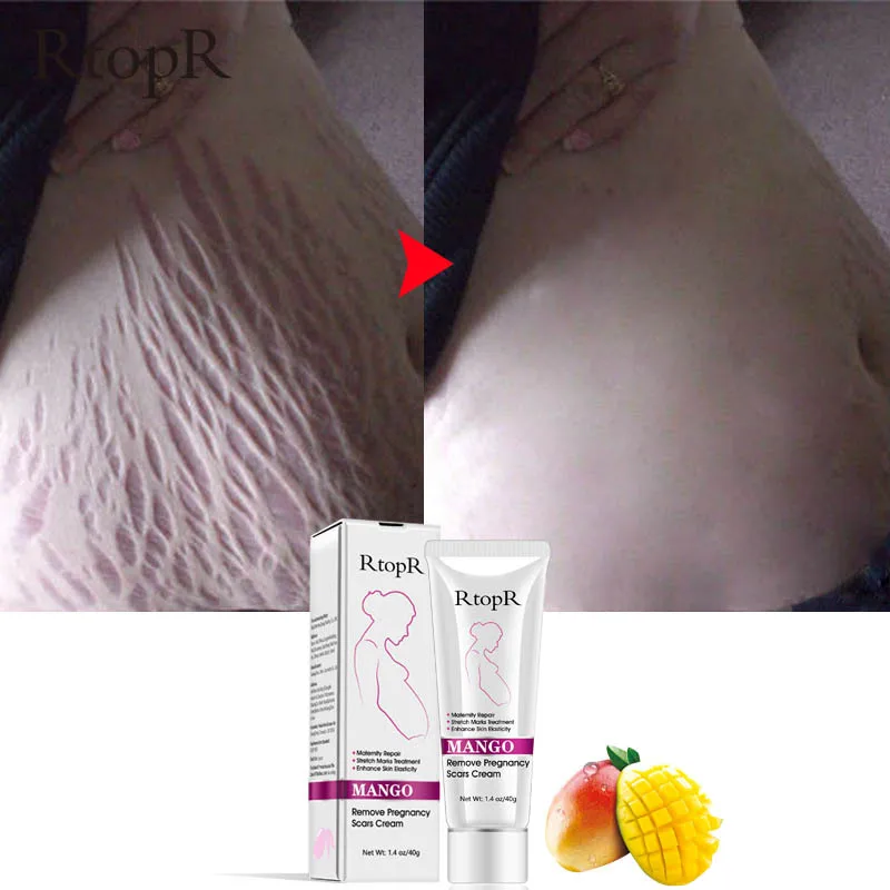 Body skin repair stretch marks removal mango remove pregnancy scars cream