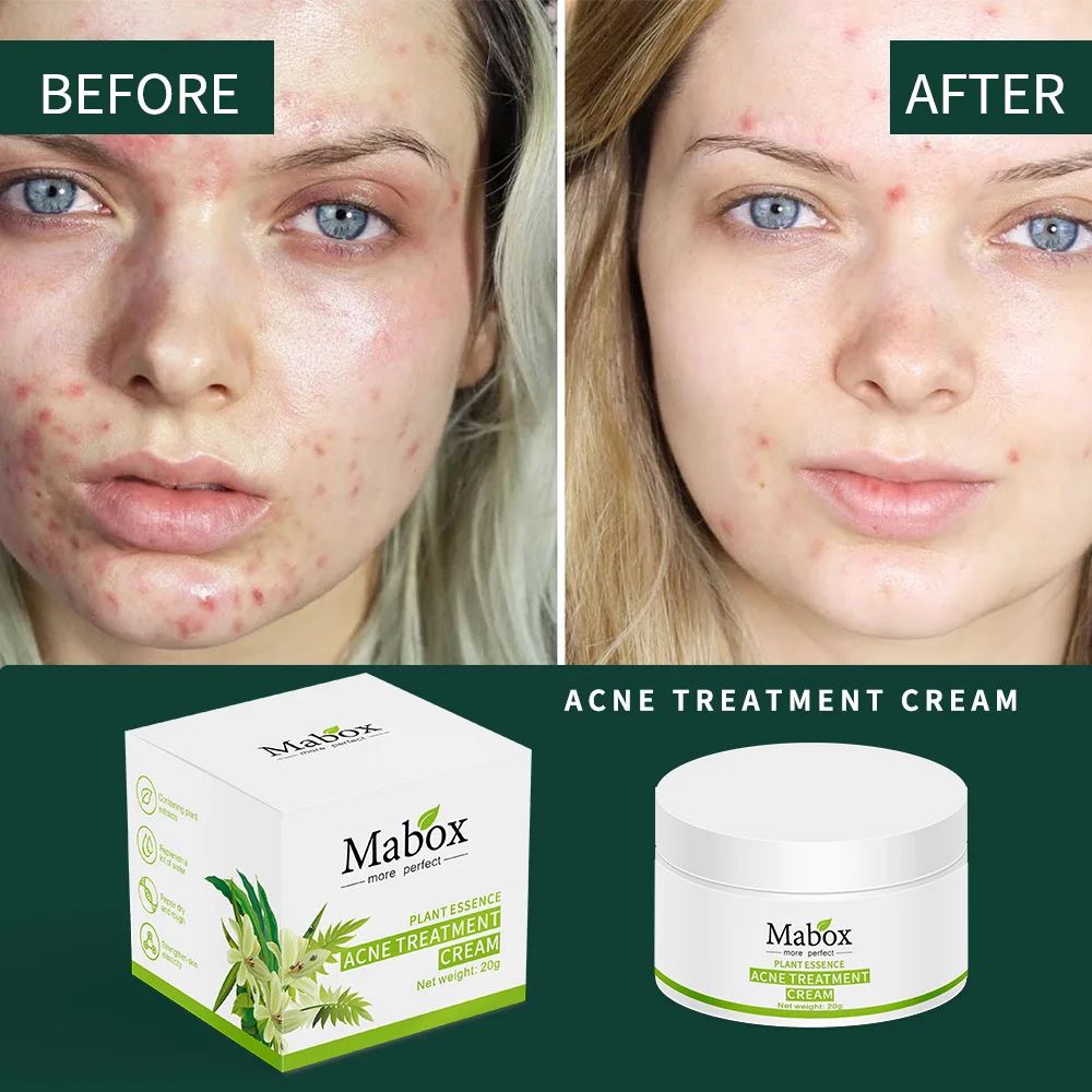
Herbal Plant Extract Anti Pimple Cream Acne Treatment Cream 